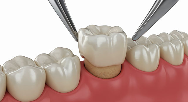 Corona de zirconia protesis